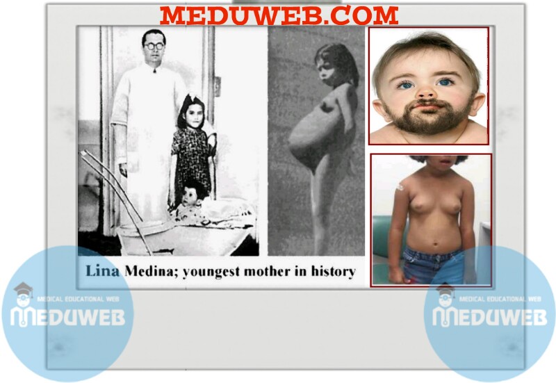 Precocious Puberty Source Meduweb com
